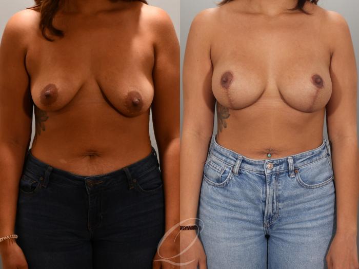 Breast Augmentation with Lift Case 1001954 Before & After Front | Serving Rochester, Syracuse & Buffalo, NY | Quatela Center for Plastic Surgery