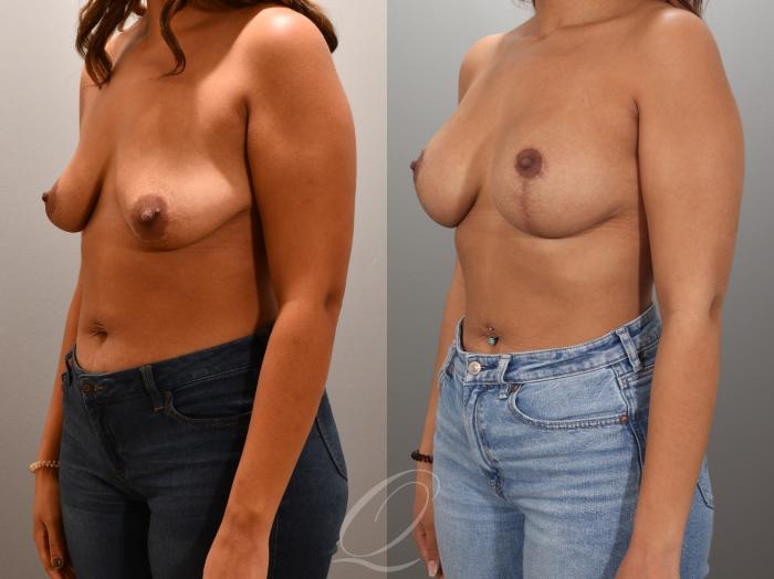 Breast Augmentation with Lift Case 1001954 Before & After Left Oblique | Serving Rochester, Syracuse & Buffalo, NY | Quatela Center for Plastic Surgery