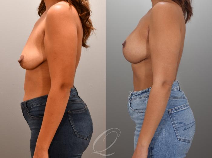 Breast Augmentation with Lift Case 1001954 Before & After Left Side | Serving Rochester, Syracuse & Buffalo, NY | Quatela Center for Plastic Surgery