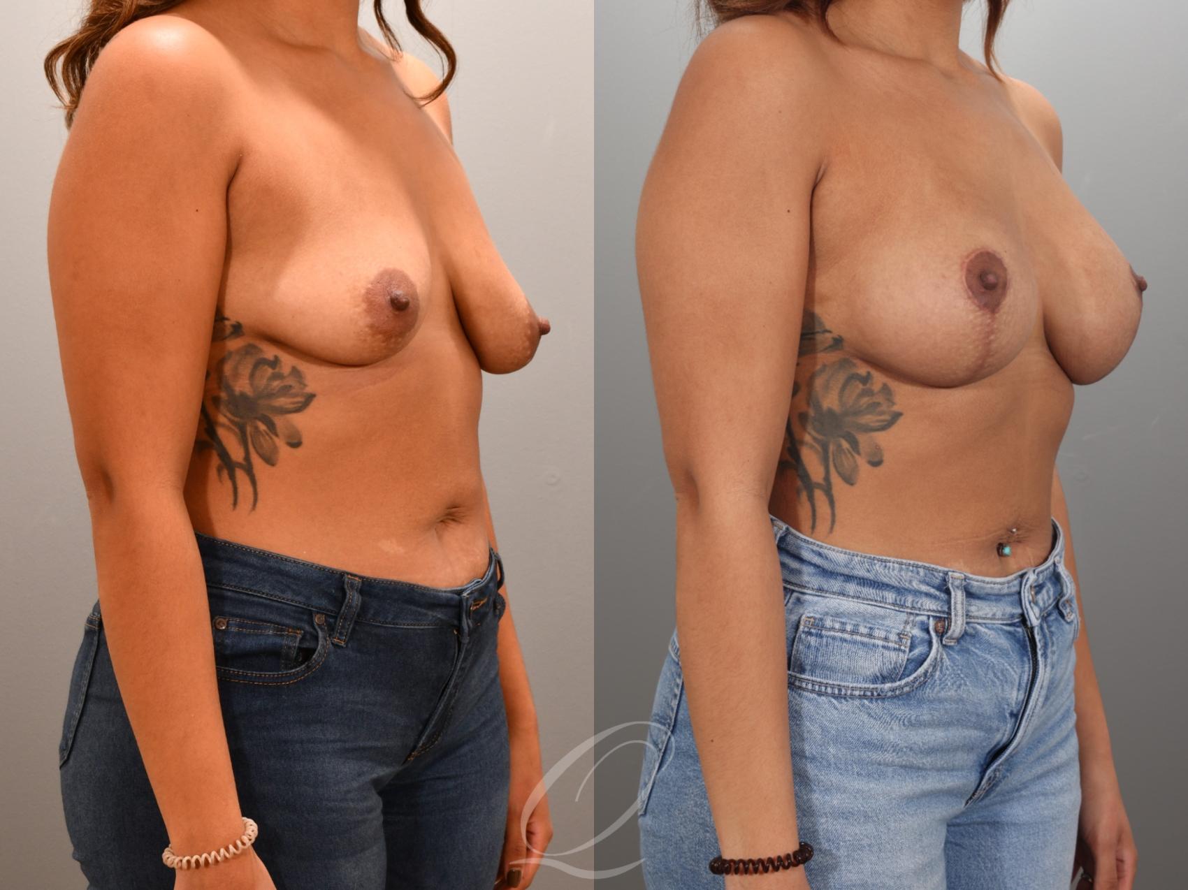 Breast Augmentation with Lift Case 1001954 Before & After Right Oblique | Serving Rochester, Syracuse & Buffalo, NY | Quatela Center for Plastic Surgery