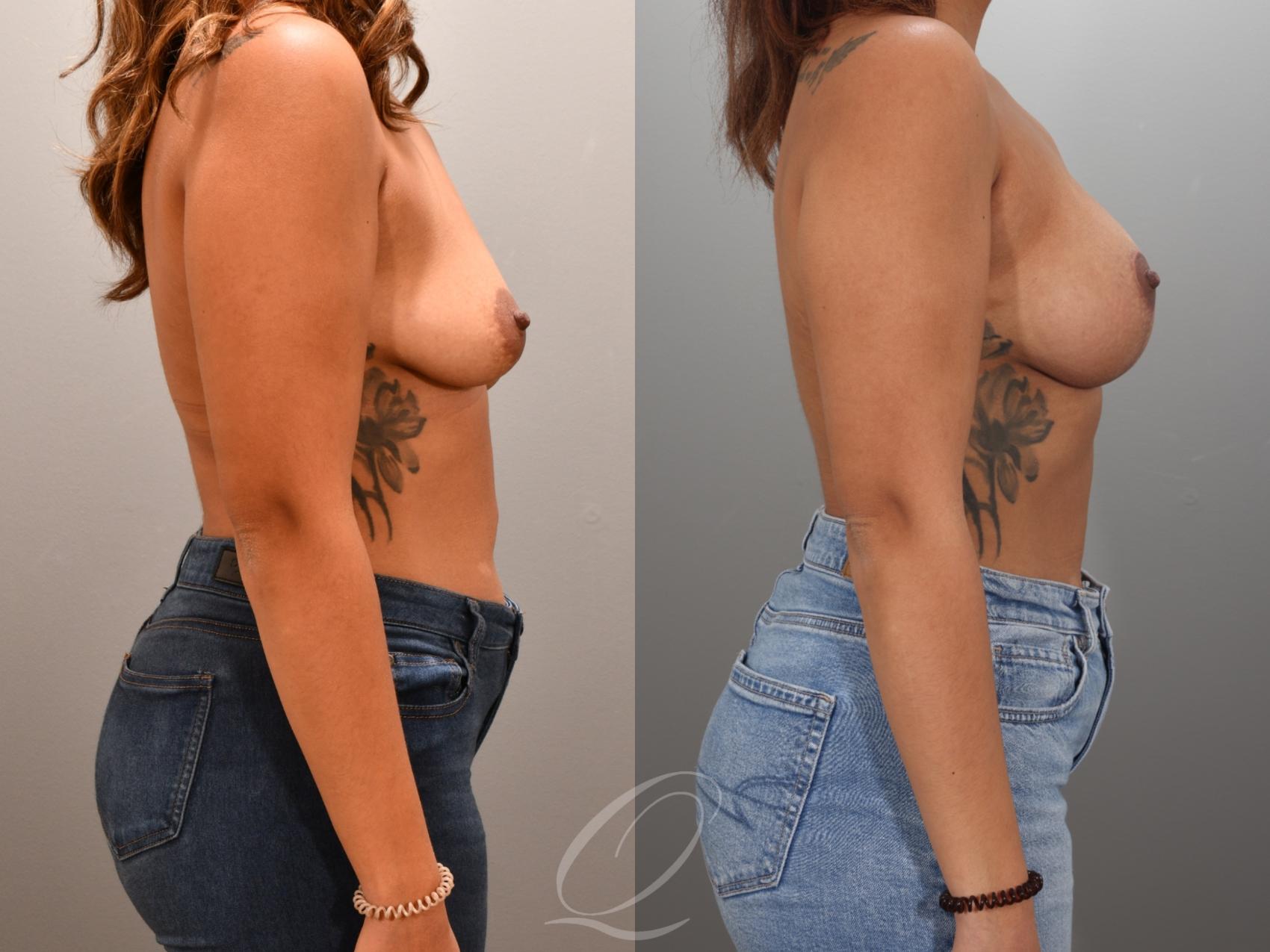 Breast Augmentation with Lift Case 1001954 Before & After Right Side | Serving Rochester, Syracuse & Buffalo, NY | Quatela Center for Plastic Surgery