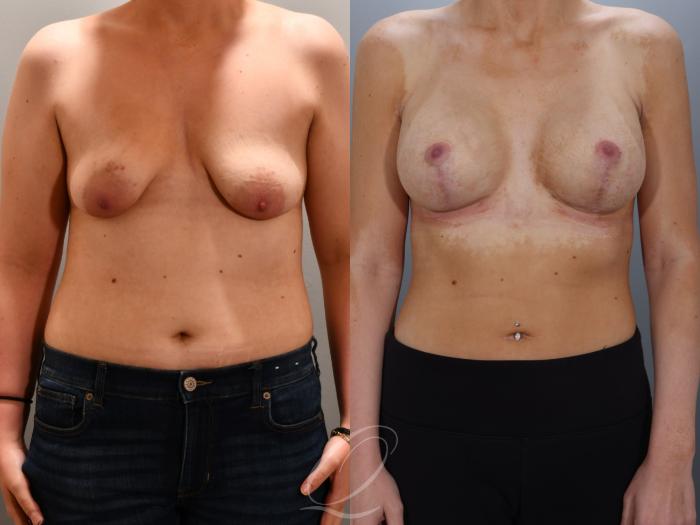 Breast Augmentation with Lift Case 1001960 Before & After Front | Serving Rochester, Syracuse & Buffalo, NY | Quatela Center for Plastic Surgery