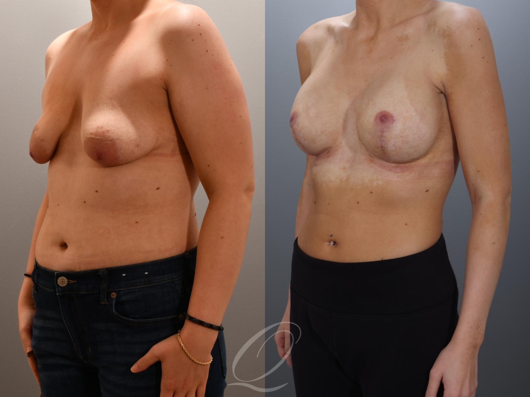 Breast Augmentation with Lift Case 1001960 Before & After Left Oblique | Serving Rochester, Syracuse & Buffalo, NY | Quatela Center for Plastic Surgery