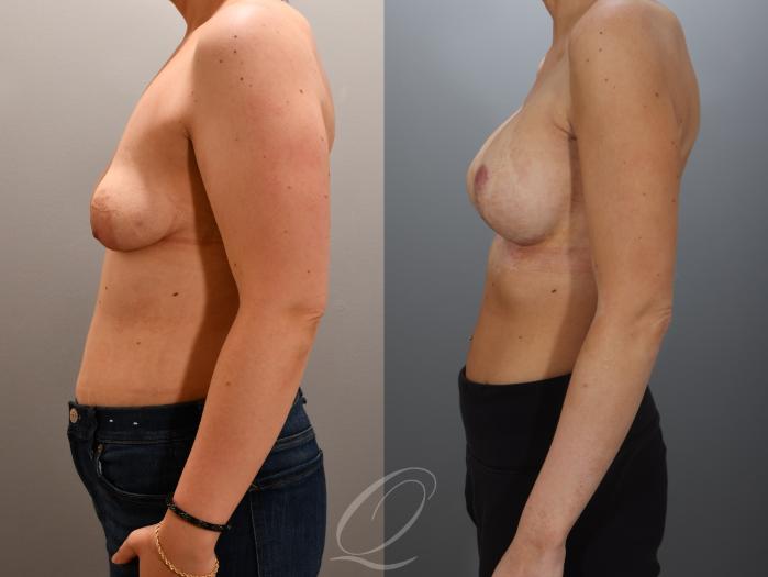 Breast Augmentation with Lift Case 1001960 Before & After Left Side | Serving Rochester, Syracuse & Buffalo, NY | Quatela Center for Plastic Surgery