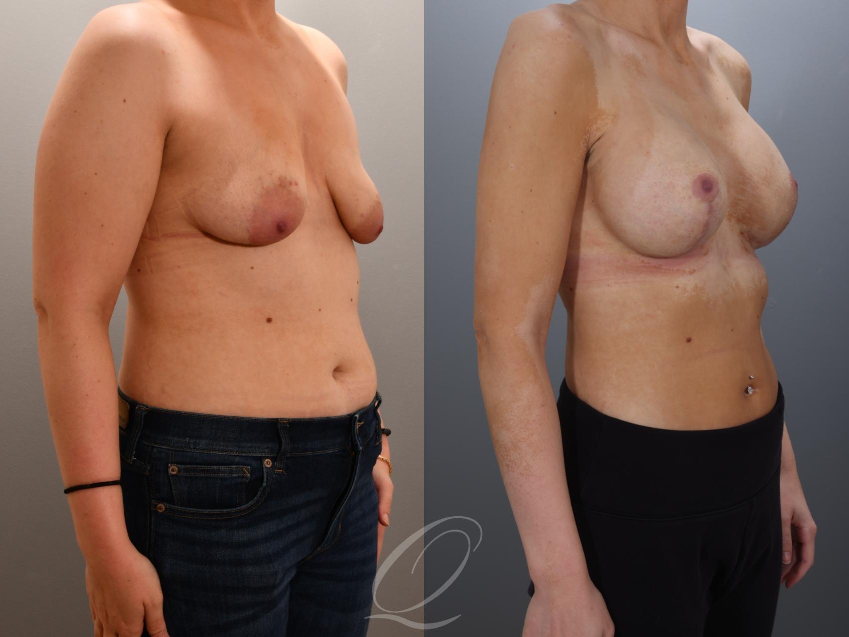 Breast Augmentation with Lift Case 1001960 Before & After Right Oblique | Serving Rochester, Syracuse & Buffalo, NY | Quatela Center for Plastic Surgery