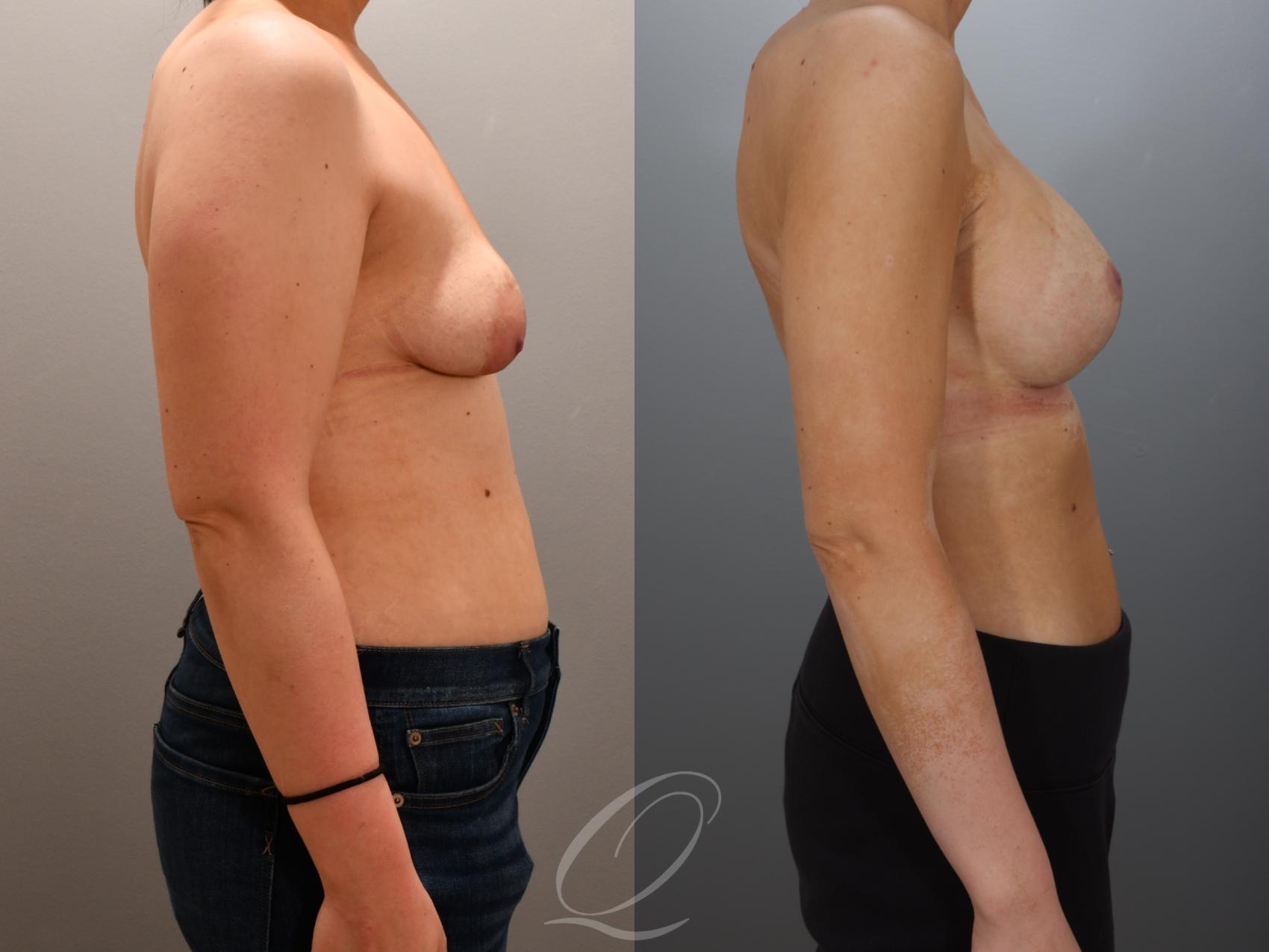 Breast Augmentation with Lift Case 1001960 Before & After Right Side | Serving Rochester, Syracuse & Buffalo, NY | Quatela Center for Plastic Surgery