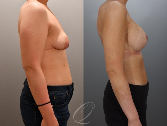 Breast Augmentation with Lift Case 1001960 Before & After Right Side | Serving Rochester, Syracuse & Buffalo, NY | Quatela Center for Plastic Surgery