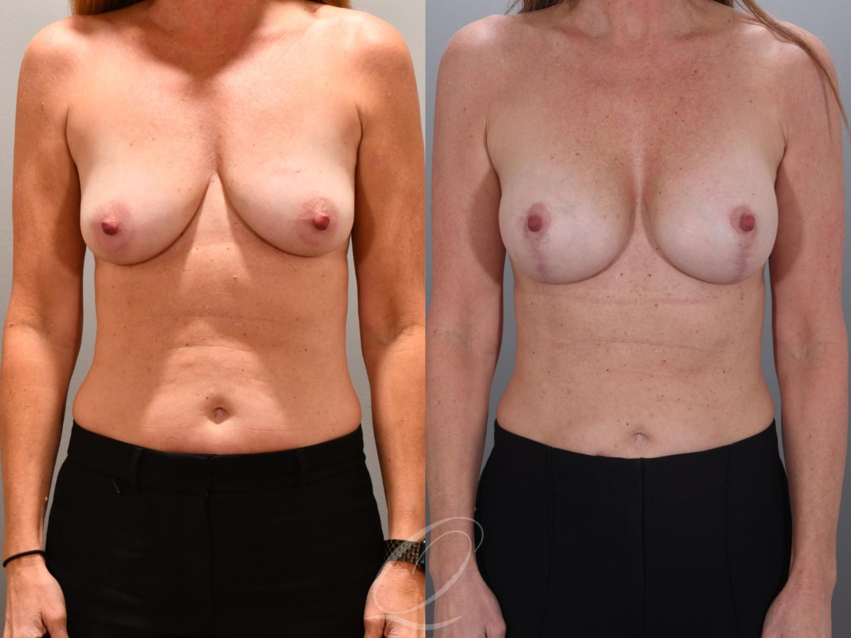 Breast Augmentation with Lift Case 1001966 Before & After Front | Serving Rochester, Syracuse & Buffalo, NY | Quatela Center for Plastic Surgery
