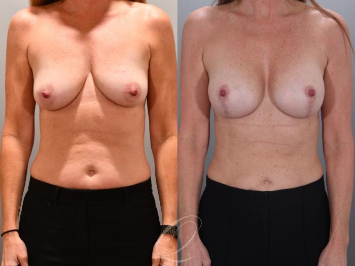 Breast Augmentation with Lift Case 1001966 Before & After Front | Serving Rochester, Syracuse & Buffalo, NY | Quatela Center for Plastic Surgery