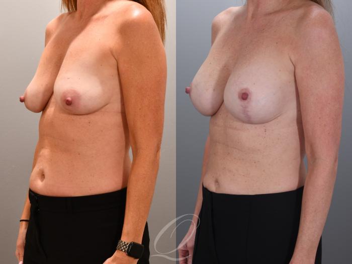 Breast Augmentation with Lift Case 1001966 Before & After Left Oblique | Serving Rochester, Syracuse & Buffalo, NY | Quatela Center for Plastic Surgery