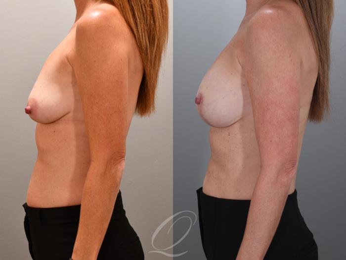 Breast Augmentation with Lift Case 1001966 Before & After Left Side | Serving Rochester, Syracuse & Buffalo, NY | Quatela Center for Plastic Surgery