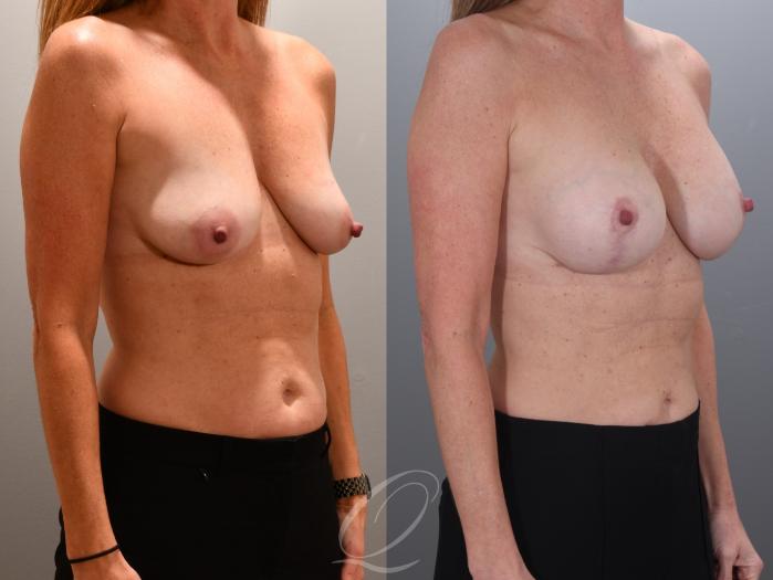 Breast Augmentation with Lift Case 1001966 Before & After Right Oblique | Serving Rochester, Syracuse & Buffalo, NY | Quatela Center for Plastic Surgery