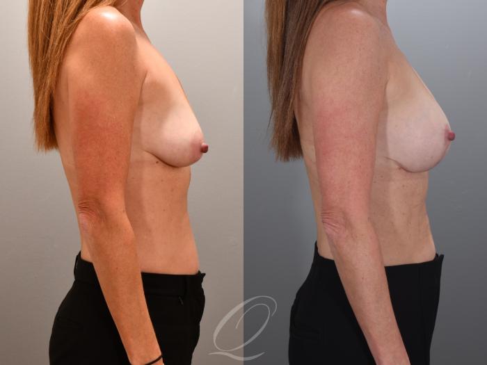 Breast Augmentation with Lift Case 1001966 Before & After Right Side | Serving Rochester, Syracuse & Buffalo, NY | Quatela Center for Plastic Surgery
