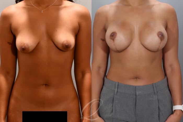 Breast Augmentation with Lift Case 1001975 Before & After Front | Serving Rochester, Syracuse & Buffalo, NY | Quatela Center for Plastic Surgery