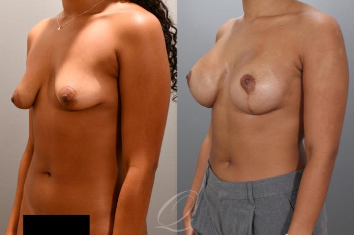 Breast Augmentation with Lift Case 1001975 Before & After Left Oblique | Serving Rochester, Syracuse & Buffalo, NY | Quatela Center for Plastic Surgery