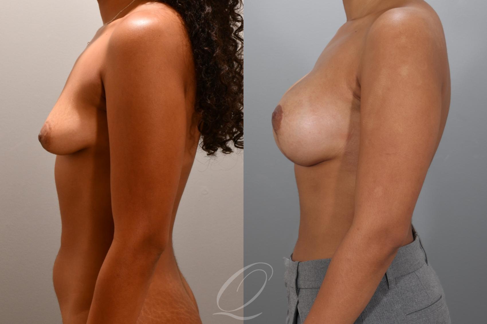 Breast Augmentation with Lift Case 1001975 Before & After Left Side | Serving Rochester, Syracuse & Buffalo, NY | Quatela Center for Plastic Surgery