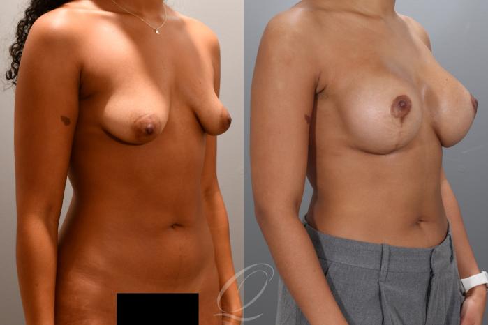 Breast Augmentation with Lift Case 1001975 Before & After Right Oblique | Serving Rochester, Syracuse & Buffalo, NY | Quatela Center for Plastic Surgery