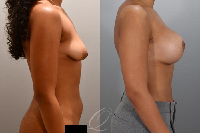 Breast Augmentation with Lift Case 1001975 Before & After Right Side | Serving Rochester, Syracuse & Buffalo, NY | Quatela Center for Plastic Surgery