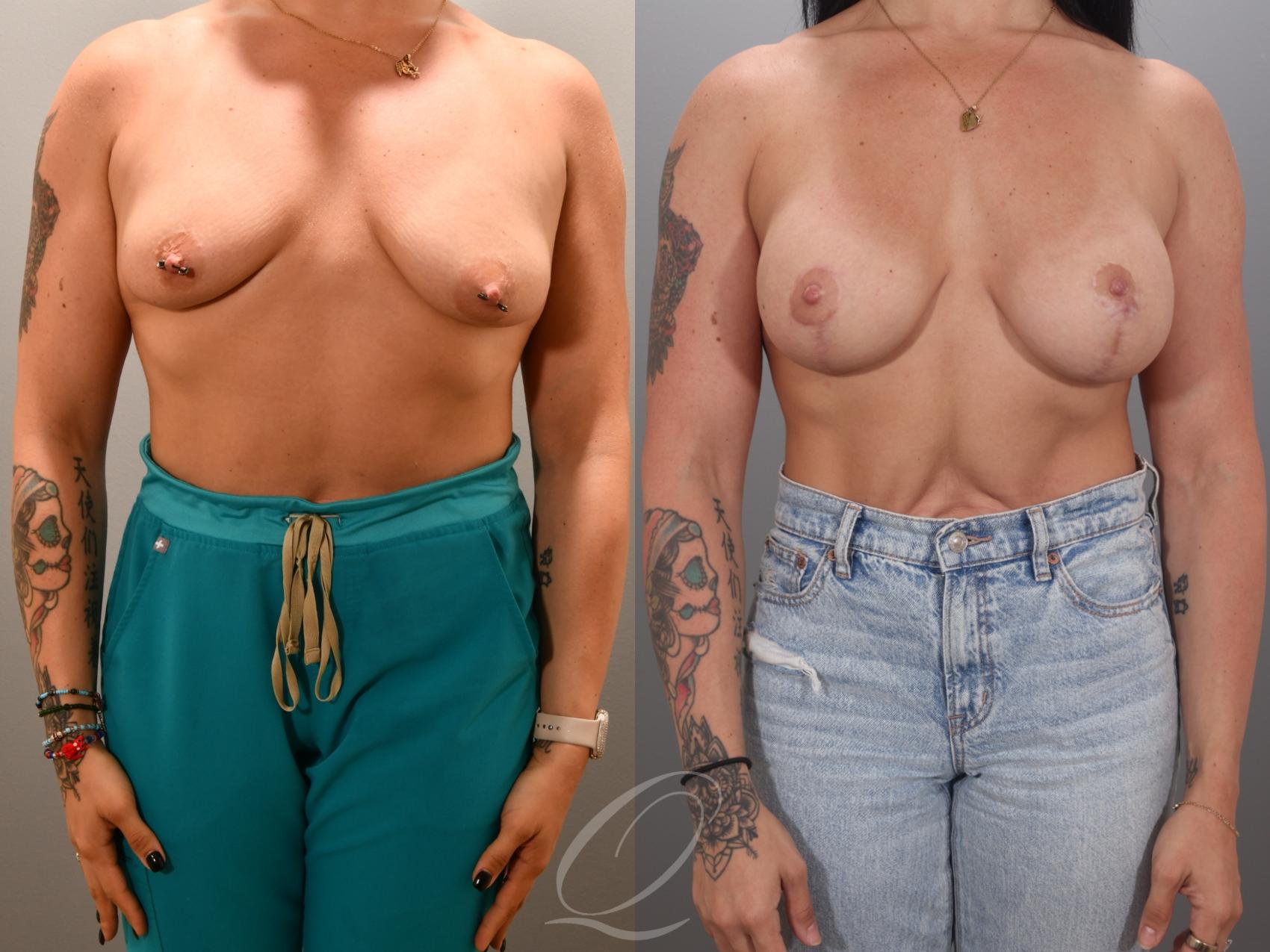 Breast Augmentation with Lift Case 1001984 Before & After Front | Serving Rochester, Syracuse & Buffalo, NY | Quatela Center for Plastic Surgery