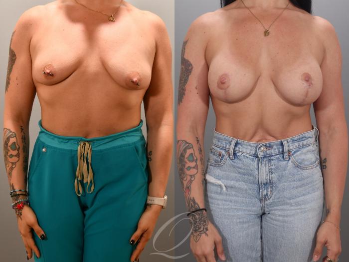 Breast Augmentation with Lift Case 1001984 Before & After Front | Serving Rochester, Syracuse & Buffalo, NY | Quatela Center for Plastic Surgery