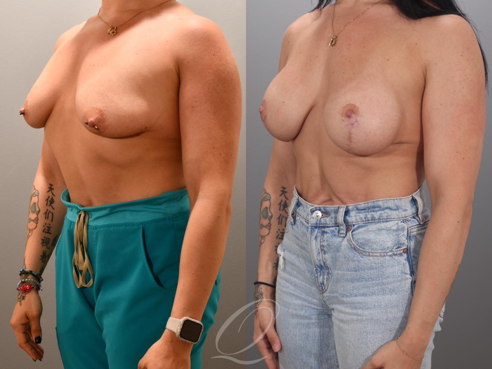 Breast Augmentation with Lift Case 1001984 Before & After Left Oblique | Serving Rochester, Syracuse & Buffalo, NY | Quatela Center for Plastic Surgery