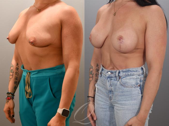 Breast Augmentation with Lift Case 1001984 Before & After Left Oblique | Serving Rochester, Syracuse & Buffalo, NY | Quatela Center for Plastic Surgery