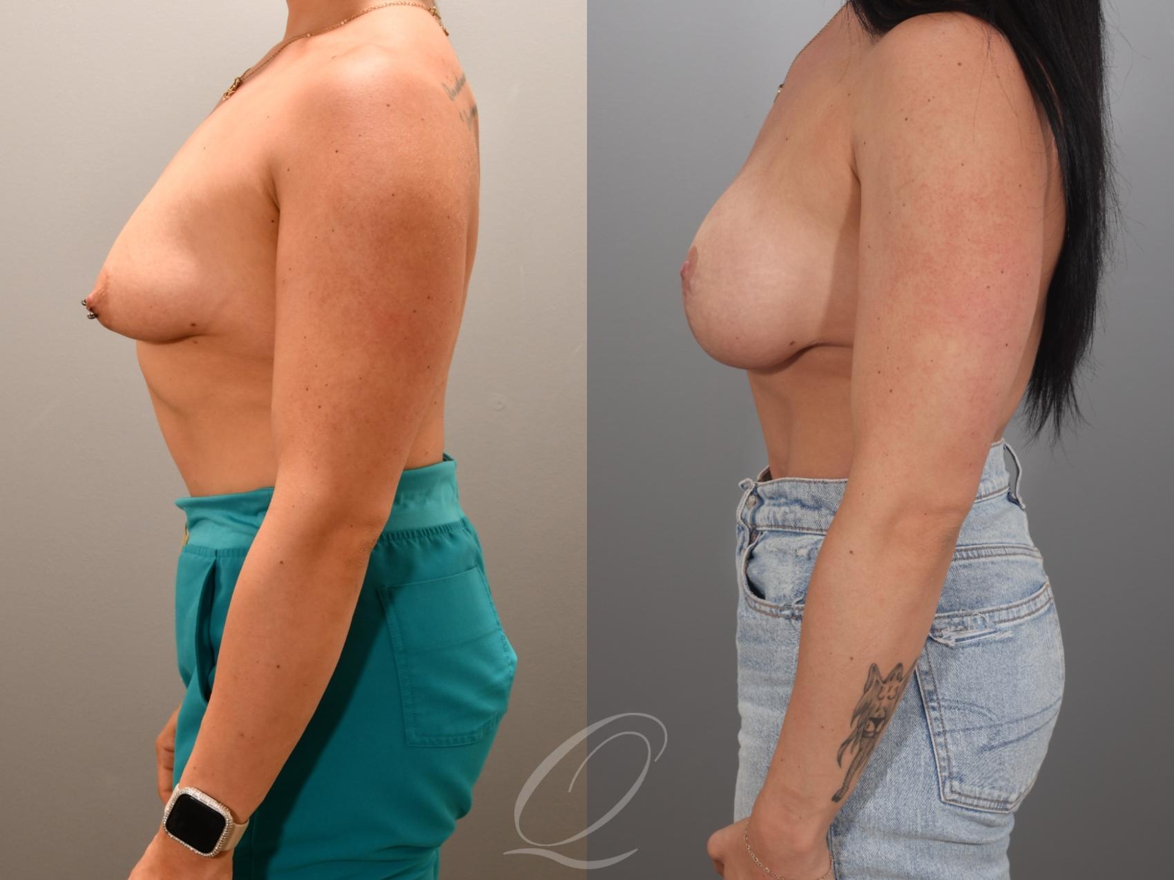 Breast Augmentation with Lift Case 1001984 Before & After Left Side | Serving Rochester, Syracuse & Buffalo, NY | Quatela Center for Plastic Surgery