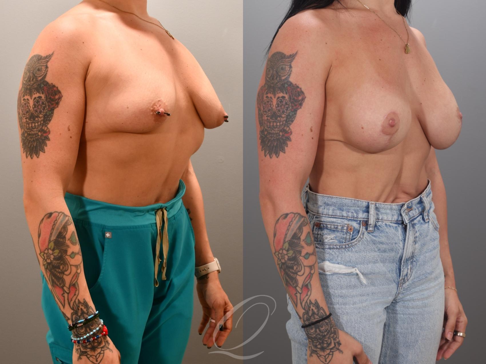 Breast Augmentation with Lift Case 1001984 Before & After Right Oblique | Serving Rochester, Syracuse & Buffalo, NY | Quatela Center for Plastic Surgery