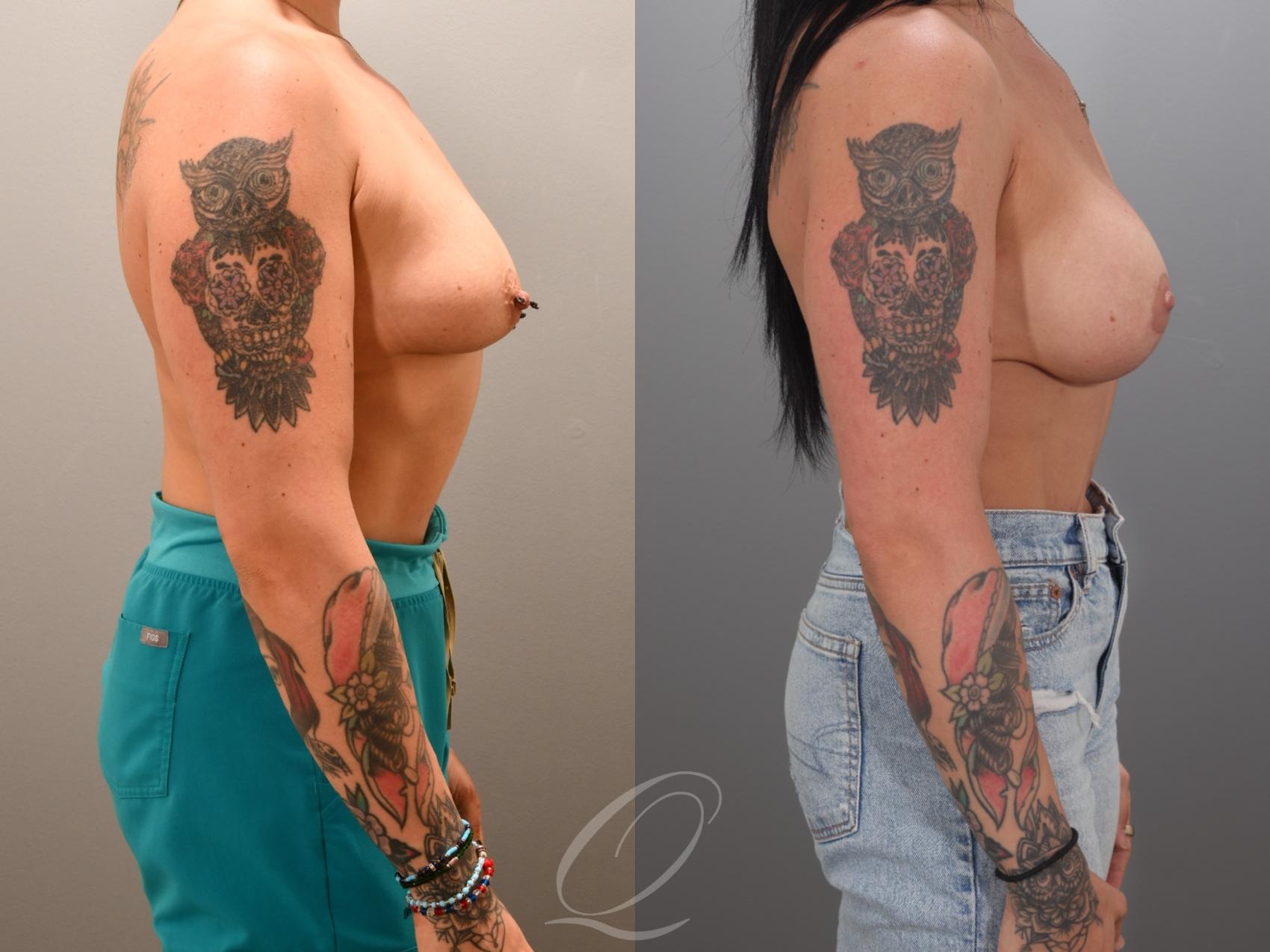 Breast Augmentation with Lift Case 1001984 Before & After Right Side | Serving Rochester, Syracuse & Buffalo, NY | Quatela Center for Plastic Surgery