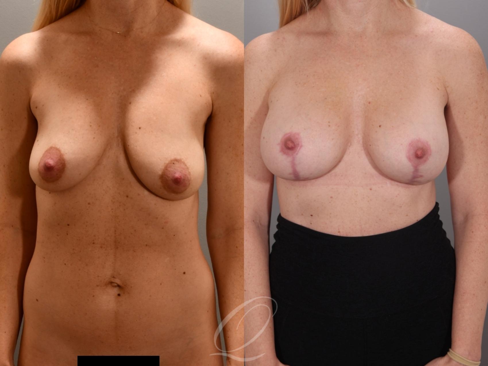 Breast Augmentation with Lift Case 1001987 Before & After Front | Serving Rochester, Syracuse & Buffalo, NY | Quatela Center for Plastic Surgery