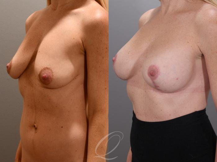 Breast Augmentation with Lift Case 1001987 Before & After Left Oblique | Serving Rochester, Syracuse & Buffalo, NY | Quatela Center for Plastic Surgery