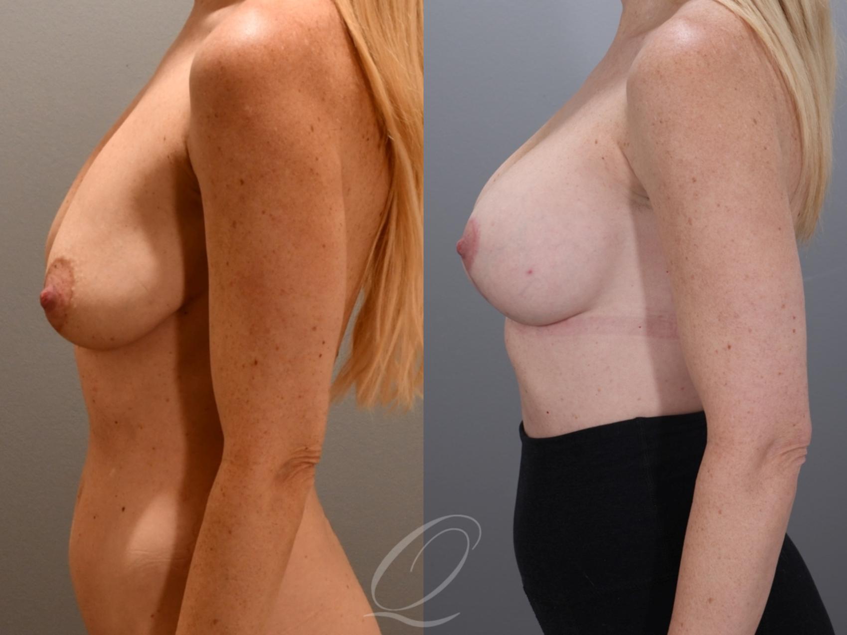 Breast Augmentation with Lift Case 1001987 Before & After Left Side | Serving Rochester, Syracuse & Buffalo, NY | Quatela Center for Plastic Surgery