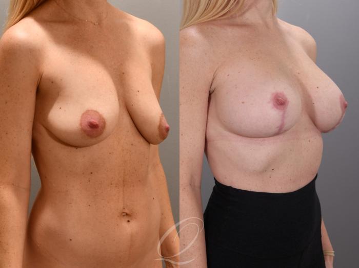Breast Augmentation with Lift Case 1001987 Before & After Right Oblique | Serving Rochester, Syracuse & Buffalo, NY | Quatela Center for Plastic Surgery