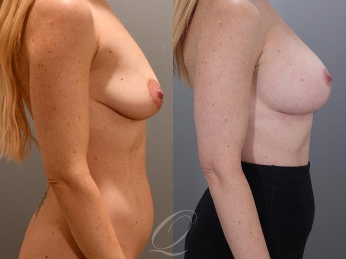 Breast Augmentation with Lift Case 1001987 Before & After Right Side | Serving Rochester, Syracuse & Buffalo, NY | Quatela Center for Plastic Surgery