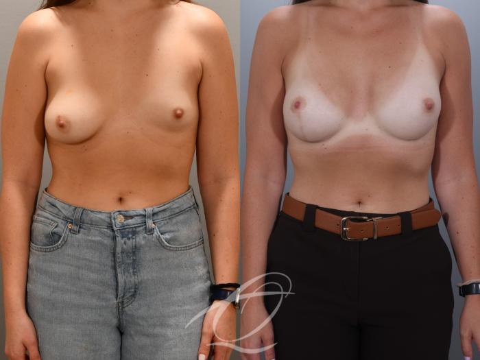 Breast Augmentation with Lift Case 1002024 Before & After Front | Serving Rochester, Syracuse & Buffalo, NY | Quatela Center for Plastic Surgery