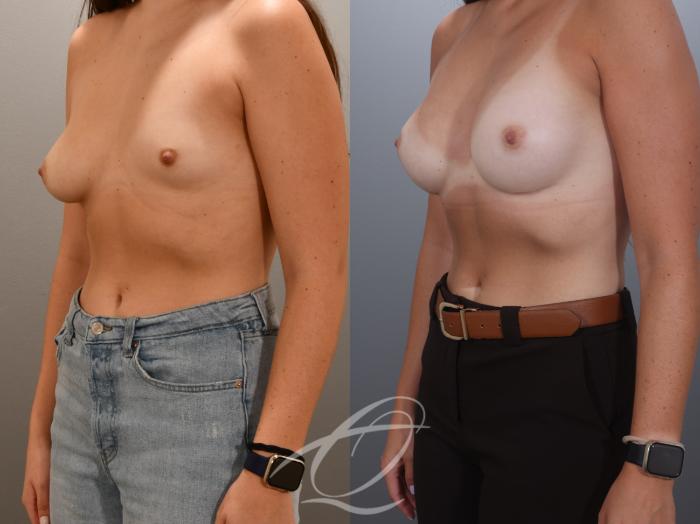Breast Augmentation with Lift Case 1002024 Before & After Left Oblique | Serving Rochester, Syracuse & Buffalo, NY | Quatela Center for Plastic Surgery