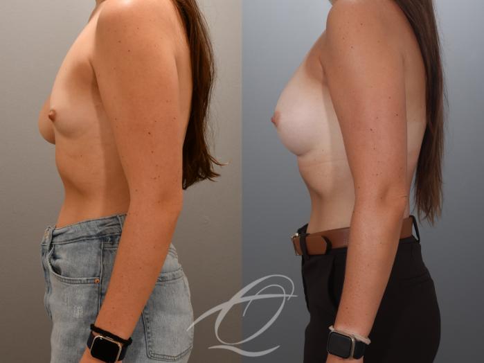 Breast Augmentation with Lift Case 1002024 Before & After Left Side | Serving Rochester, Syracuse & Buffalo, NY | Quatela Center for Plastic Surgery