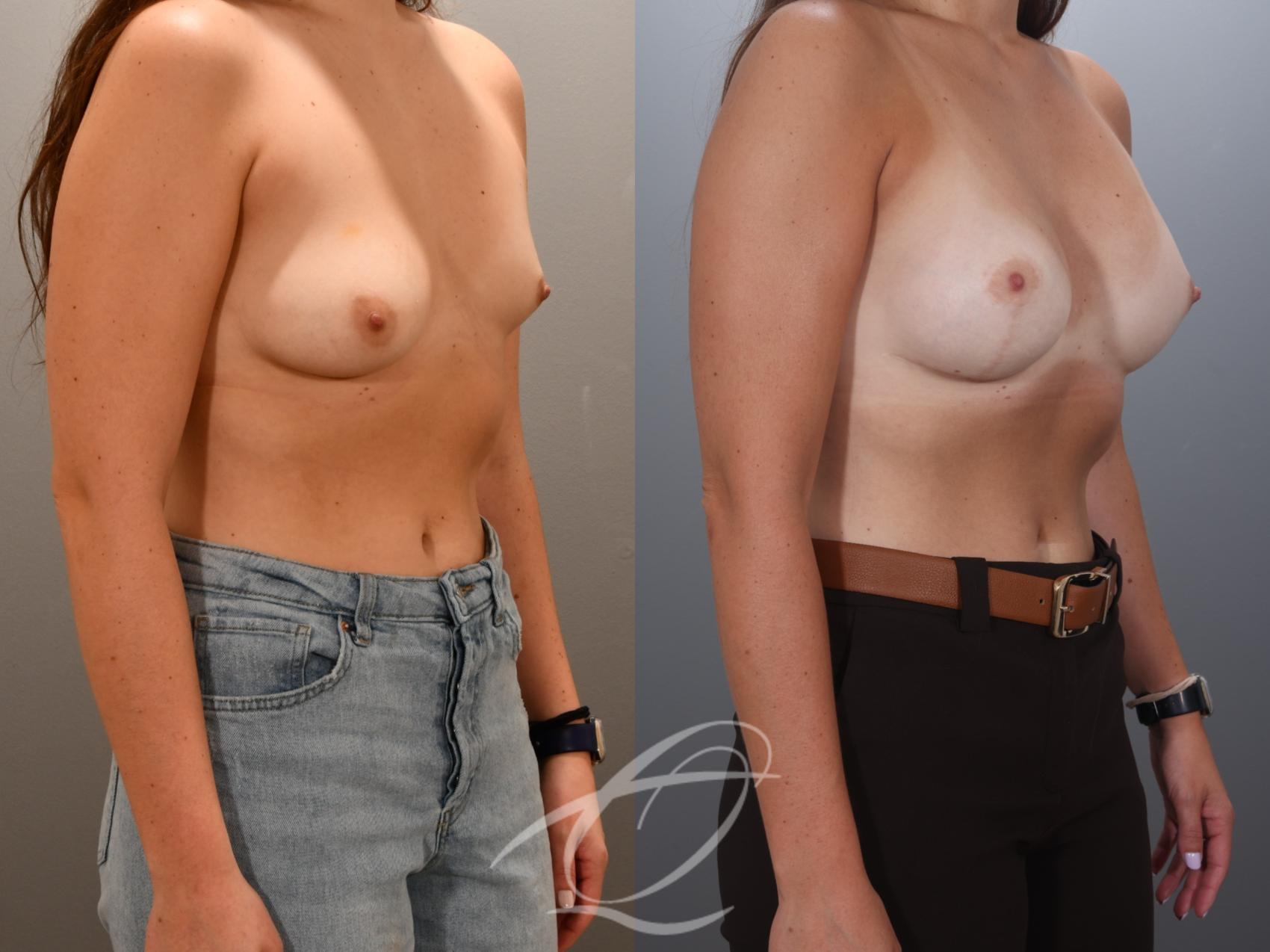 Breast Augmentation with Lift Case 1002024 Before & After Right Oblique | Serving Rochester, Syracuse & Buffalo, NY | Quatela Center for Plastic Surgery