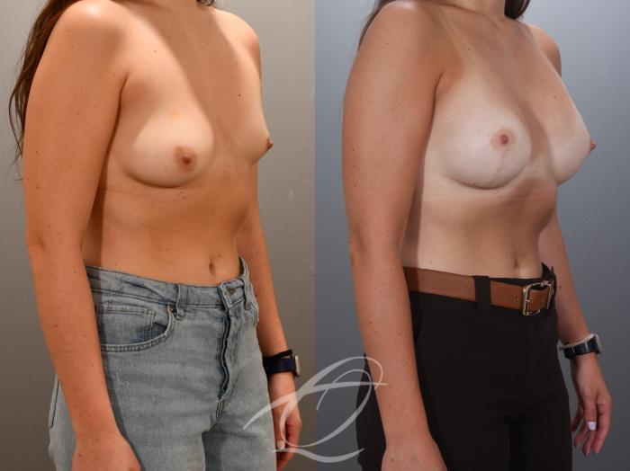 Breast Augmentation with Lift Case 1002024 Before & After Right Oblique | Serving Rochester, Syracuse & Buffalo, NY | Quatela Center for Plastic Surgery