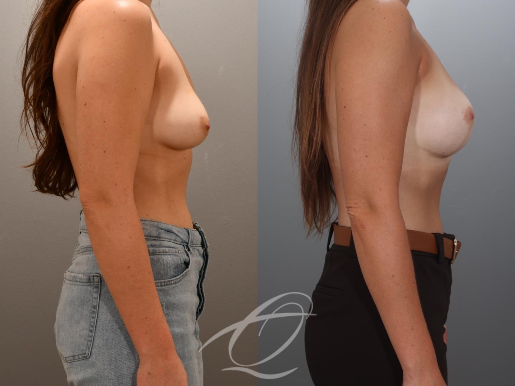 Breast Augmentation with Lift Case 1002024 Before & After Right Side | Serving Rochester, Syracuse & Buffalo, NY | Quatela Center for Plastic Surgery