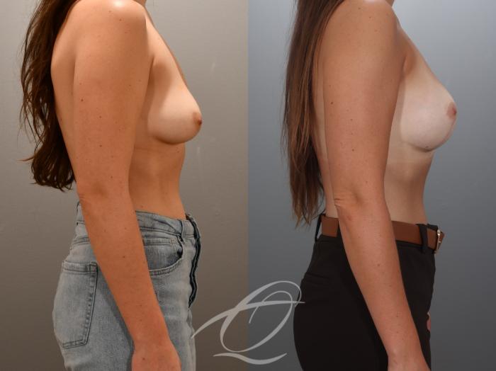 Breast Augmentation with Lift Case 1002024 Before & After Right Side | Serving Rochester, Syracuse & Buffalo, NY | Quatela Center for Plastic Surgery