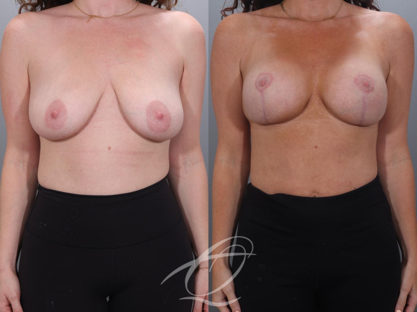 Breast Augmentation with Lift Case 1002027 Before & After Front | Serving Rochester, Syracuse & Buffalo, NY | Quatela Center for Plastic Surgery