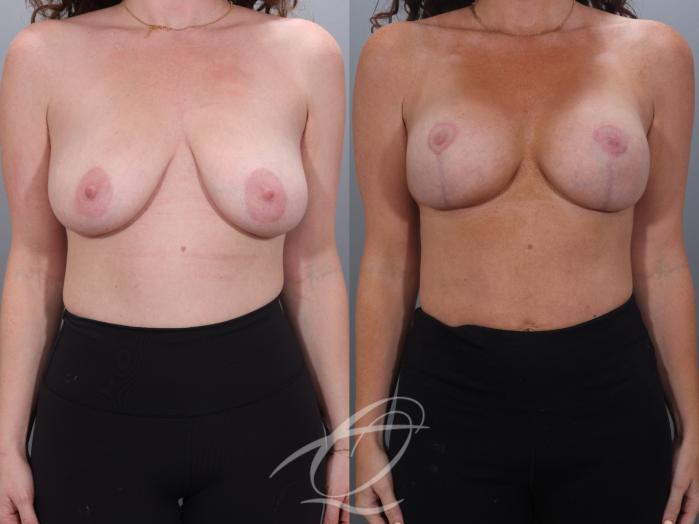 Breast Augmentation with Lift Case 1002027 Before & After Front | Serving Rochester, Syracuse & Buffalo, NY | Quatela Center for Plastic Surgery