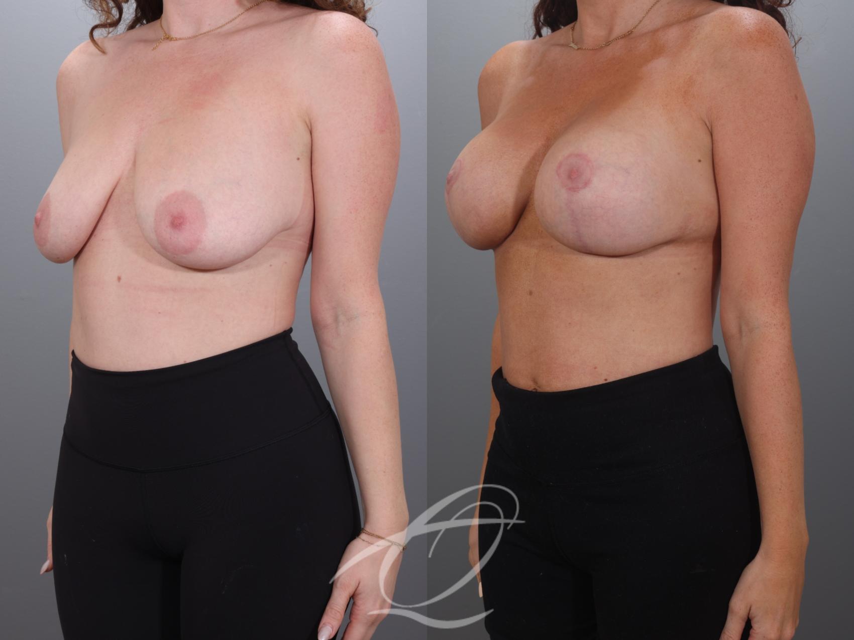Breast Augmentation with Lift Case 1002027 Before & After Left Oblique | Serving Rochester, Syracuse & Buffalo, NY | Quatela Center for Plastic Surgery