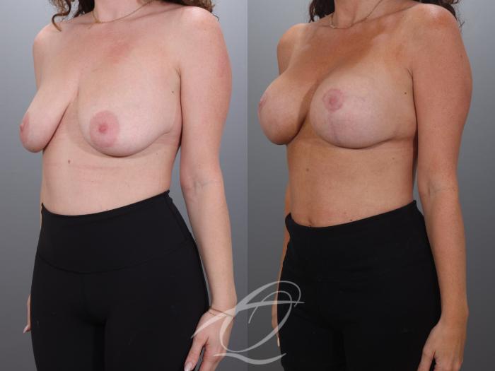 Breast Augmentation with Lift Case 1002027 Before & After Left Oblique | Serving Rochester, Syracuse & Buffalo, NY | Quatela Center for Plastic Surgery