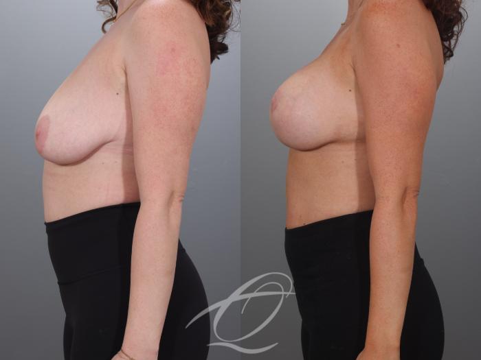 Breast Augmentation with Lift Case 1002027 Before & After Left Side | Serving Rochester, Syracuse & Buffalo, NY | Quatela Center for Plastic Surgery