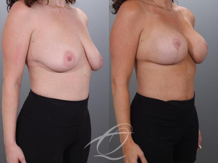 Breast Augmentation with Lift Case 1002027 Before & After Right Oblique | Serving Rochester, Syracuse & Buffalo, NY | Quatela Center for Plastic Surgery
