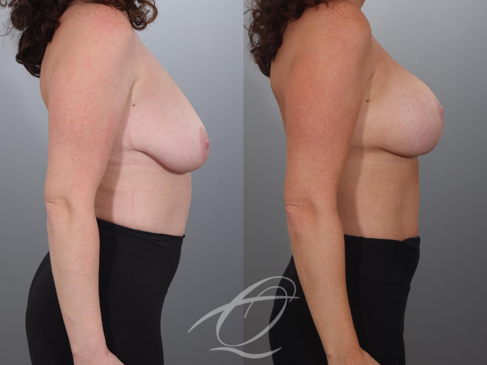 Breast Augmentation with Lift Case 1002027 Before & After Right Side | Serving Rochester, Syracuse & Buffalo, NY | Quatela Center for Plastic Surgery