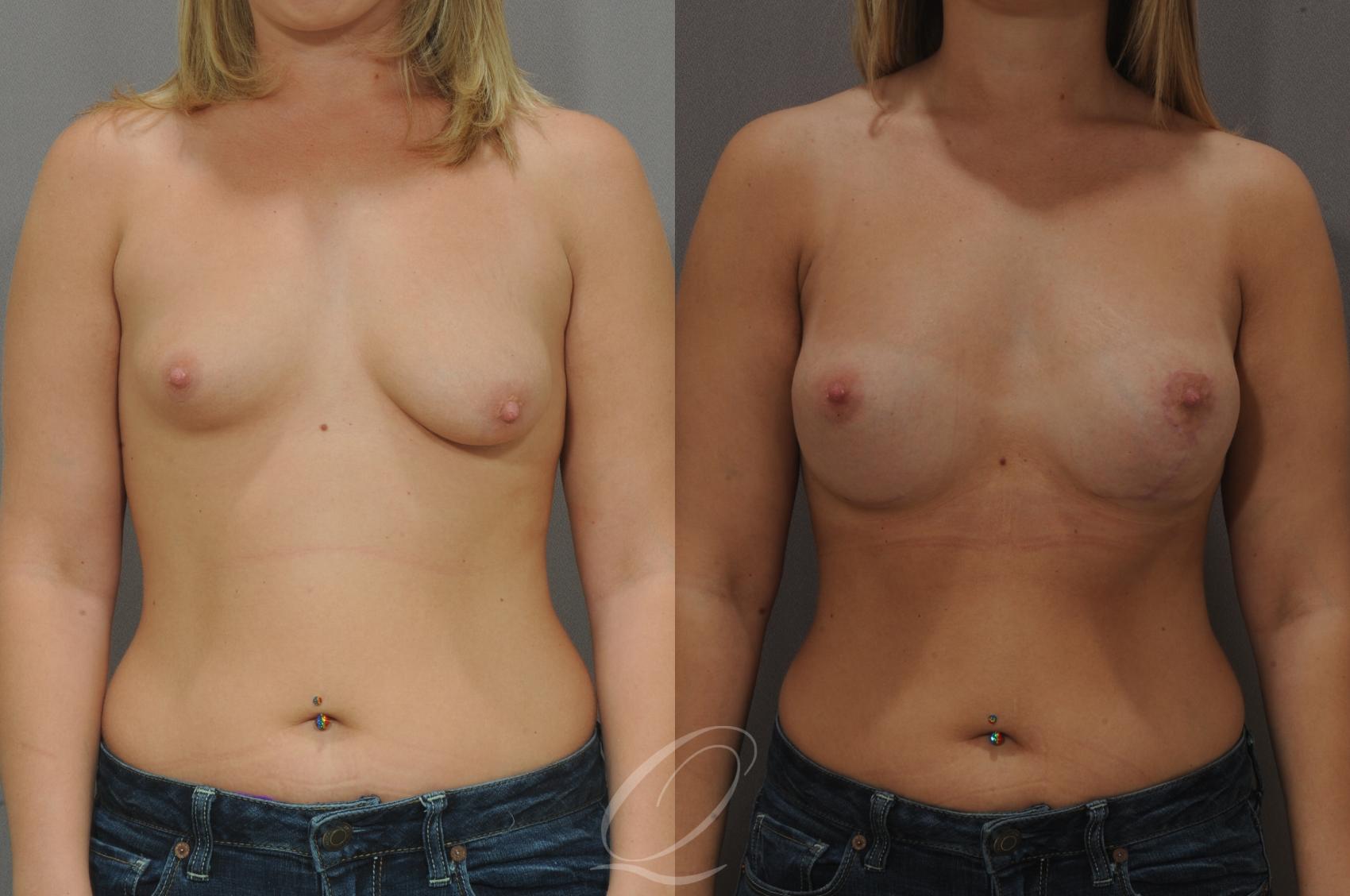 Breast Augmentation with Lift Case 103 Before & After View #1 | Serving Rochester, Syracuse & Buffalo, NY | Quatela Center for Plastic Surgery