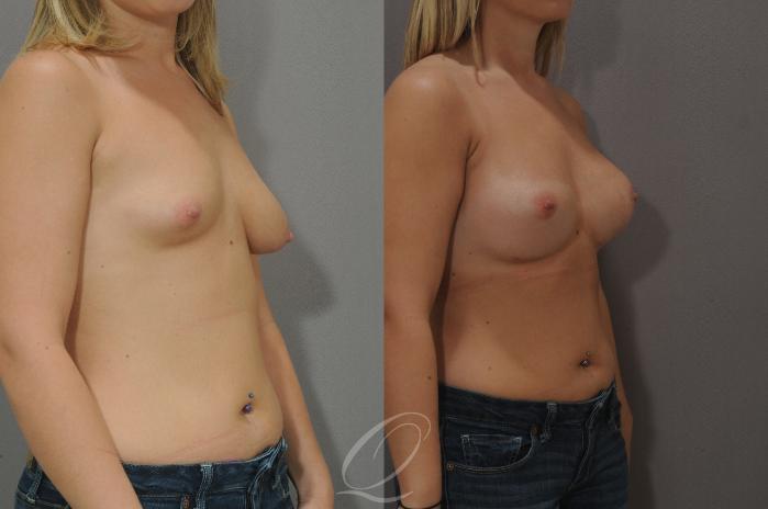 Breast Augmentation with Lift Case 103 Before & After View #2 | Serving Rochester, Syracuse & Buffalo, NY | Quatela Center for Plastic Surgery
